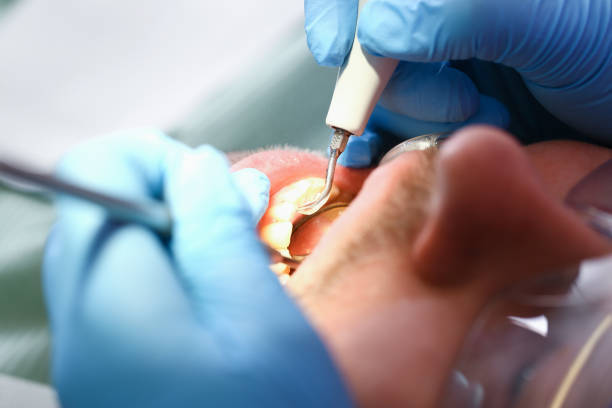 Best Dental Abscess Treatment in Athens, WV
