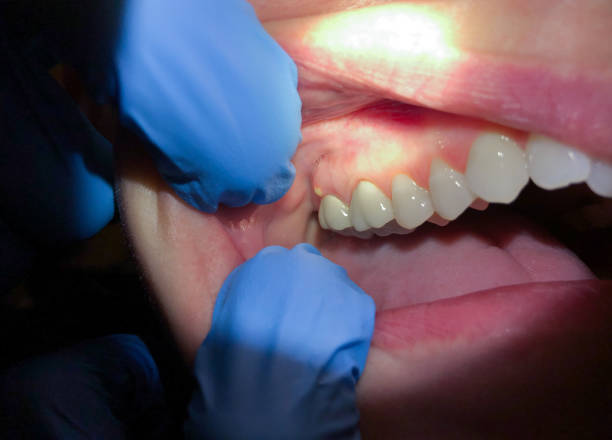 Best Emergency Care for Gum Disease in Athens, WV